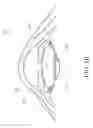 Fig. 07 - Membrane for protecting intraocular tissues and the protection methods used thereof