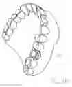 Fig. 18 - Dental tool and guidance devices