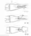 Fig. 13 - ANCHORING MECHANISMS AND SYSTEMS FOR ENDOLUMINAL DEVICES