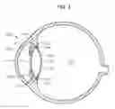 Fig. 02 - Accommodating intraocular lens