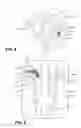 Fig. 04 - Vocal cord medialization