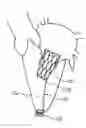 Fig. 01 - Prosthetic mitral valve coaptation enhancement device