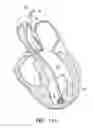 Fig. 07 - System for improving cardiac function by sealing a partitioning membrane within a ventricle
