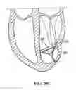Fig. 22 - System for improving cardiac function by sealing a partitioning membrane within a ventricle
