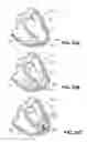 Fig. 35 - System for improving cardiac function by sealing a partitioning membrane within a ventricle