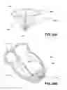 Fig. 40 - System for improving cardiac function by sealing a partitioning membrane within a ventricle