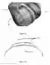Fig. 03 - METHOD AND NODE FOR MANUFACTURING A SURGICAL KIT FOR CARTILAGE REPAIR