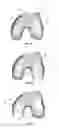 Fig. 03 - Extended patellofemoral
