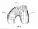 Fig. 04 - Extended patellofemoral