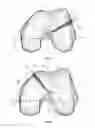Fig. 05 - Extended patellofemoral