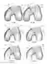Fig. 07 - Extended patellofemoral