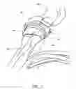 Fig. 07 - HUMERAL COMPONENT OF A SHOULDER JOINT PROSTHESIS