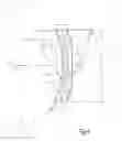 Fig. 04 - Interposition implants for the hand