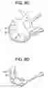 Fig. 08 - Expandable Ring Intervertebral Fusion Device