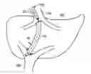 Fig. 01 - STENTS FOR PLACEMENT IN AN ANATOMICAL PASSAGEWAY AND METHODS