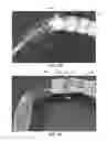 Fig. 15 - Thin-walled scaffolds having flexible distal end