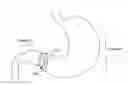 Fig. 01 - Intragastric device with expandable portions