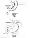 Fig. 02 - METHODS OF PERFORMING A BARIATRIC PROCEDURE AND SURGICAL DEVICES FOR USE THEREWITH
