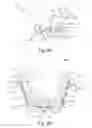 Fig. 11 - Oral orthotic systems, devices and methods for use in connection with sleep-disordered breathing