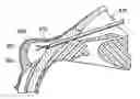 Fig. 01 - Intraocular shunt insertion techniques