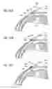 Fig. 28 - Intraocular shunt insertion techniques