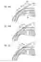 Fig. 28 - Intraocular shunt inserter