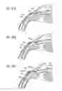 Fig. 29 - Intraocular shunt inserter
