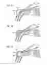 Fig. 31 - Intraocular shunt inserter