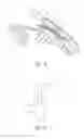 Fig. 12 - Intraocular shunt implantation methods and devices
