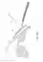Fig. 43 - Intraocular shunt implantation methods and devices