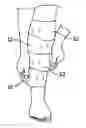 Fig. 01 - Two-part non-planar graduated compression device for the treatment of circulatory disorders
