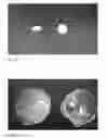 Fig. 03 - Misoprostol dispersible tablet