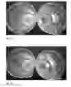 Fig. 04 - Misoprostol dispersible tablet