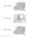 Fig. 02 - Fibrosis-causing agent