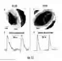 Fig. 12 - Engineered cardiac derived compositions and methods of use