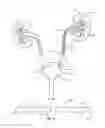 Fig. 02 - Ureteral stents