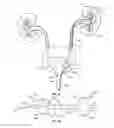 Fig. 03 - Ureteral stents