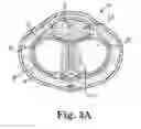 Fig. 04 - Method of using a grooved dilator and implanting a prosthetic in a penis