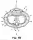 Fig. 05 - Method of using a grooved dilator and implanting a prosthetic in a penis