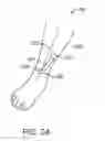 Fig. 15 - Miniature implantable neurostimulator system for sciatic nerves and their branches