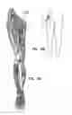 Fig. 11 - SYSTEM AND METHOD FOR TREATMENT OF PAIN RELATED TO LIMB JOINT REPLACEMENT SURGERY