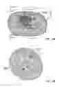 Fig. 13 - SYSTEM AND METHOD FOR TREATMENT OF PAIN RELATED TO LIMB JOINT REPLACEMENT SURGERY