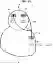 Fig. 16 - TRANSCRANIAL CURRENT STIMULATION (TCS) APPARATUS
