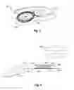 Fig. 03 - Fixation of a removable magnet or a similar element in an elastic implant material