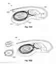 Fig. 07 - Fixation of a removable magnet or a similar element in an elastic implant material