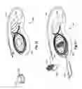 Fig. 09 - Fixation of a removable magnet or a similar element in an elastic implant material