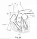 Fig. 12 - Catheter and electrode systems for electrical neuromodulation
