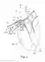 Fig. 06 - Methods for electrical neuromodulation of the heart