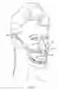 Fig. 02 - METHOD AND APPARATUS FOR TOOTH REGULATION WITH HEAVY FORCES