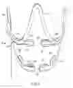 Fig. 03 - METHOD AND APPARATUS FOR TOOTH REGULATION WITH HEAVY FORCES